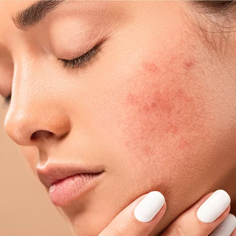 Discover holistic skin care solutions to treat eczema, psoriasis and dermatitis!
