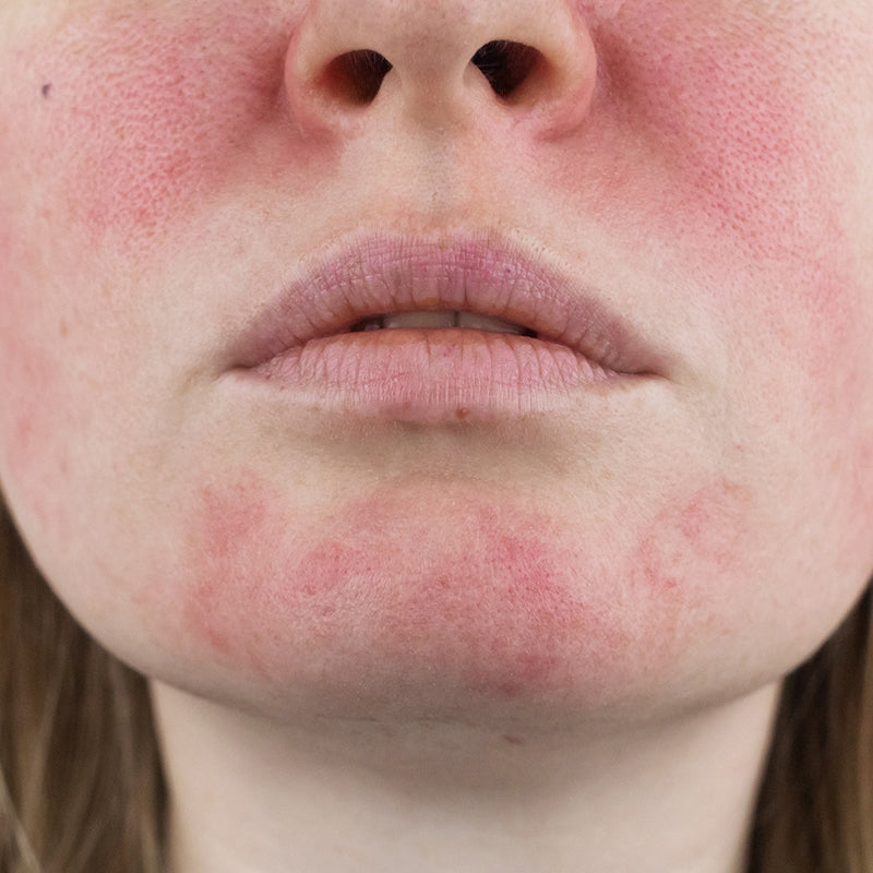 Skinflammation: Calm the Fire, Glow Naturally